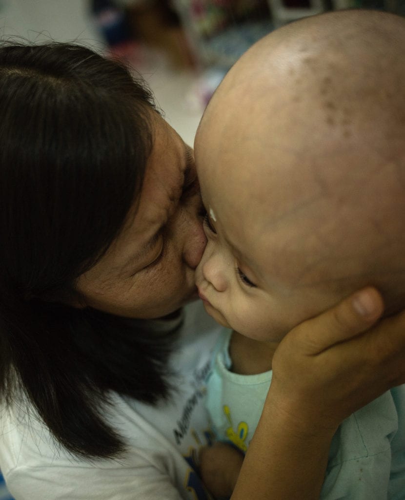 1-year old Ho Chan Dieu Hien gets a hug by Pham who is a volunteer. This is the only time when Hien is not lying on his back and staring into the ceiling.