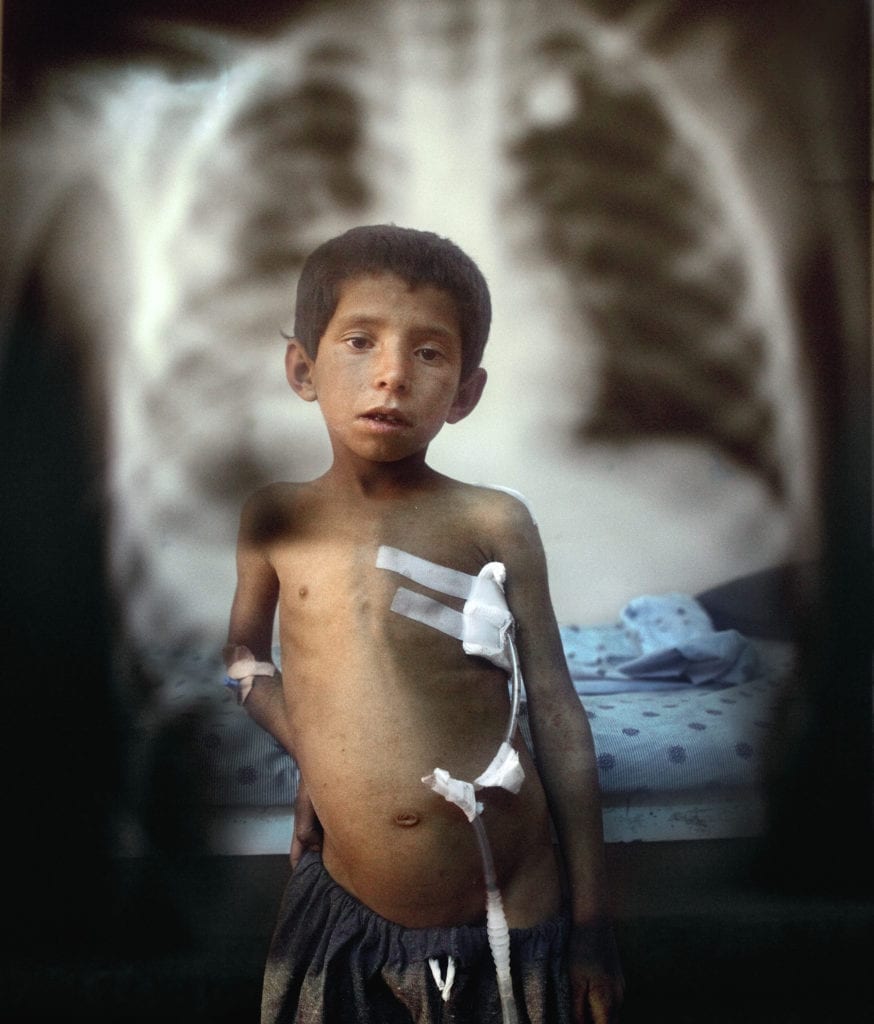 7 yr old patient stands alongside X ray showing bullet