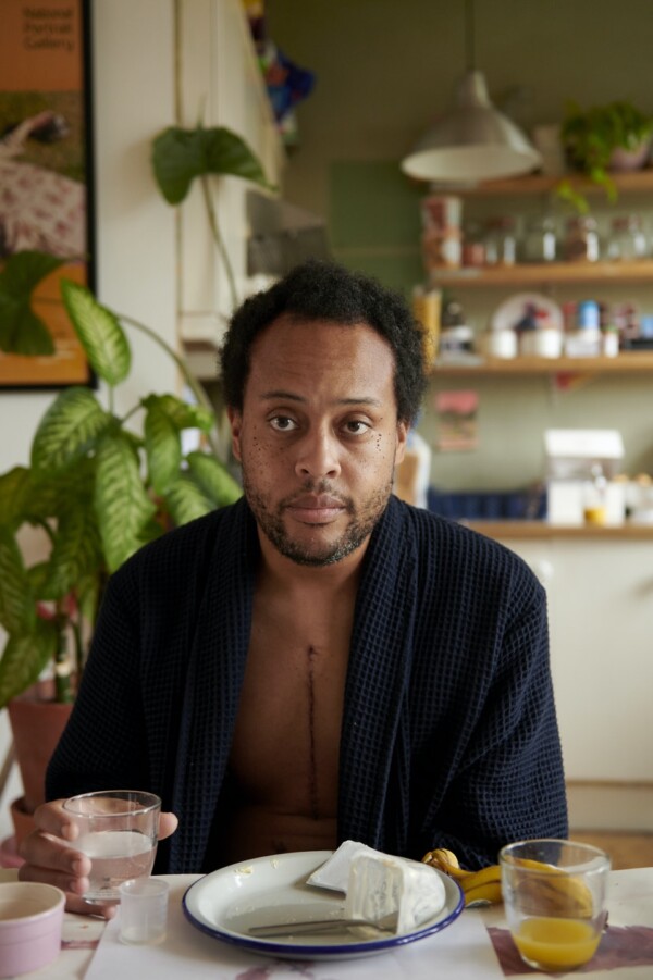 Michael, 11 days post-surgery