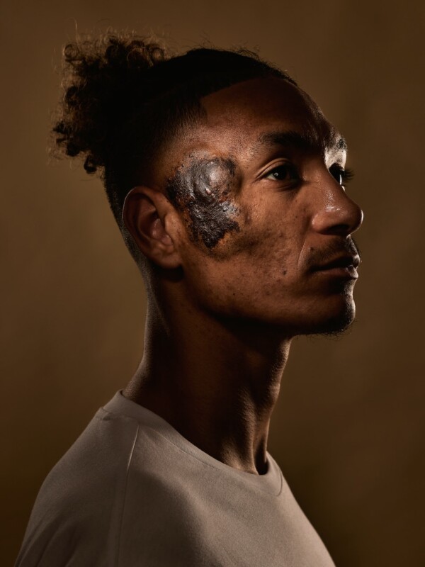 Sean & his birthmark